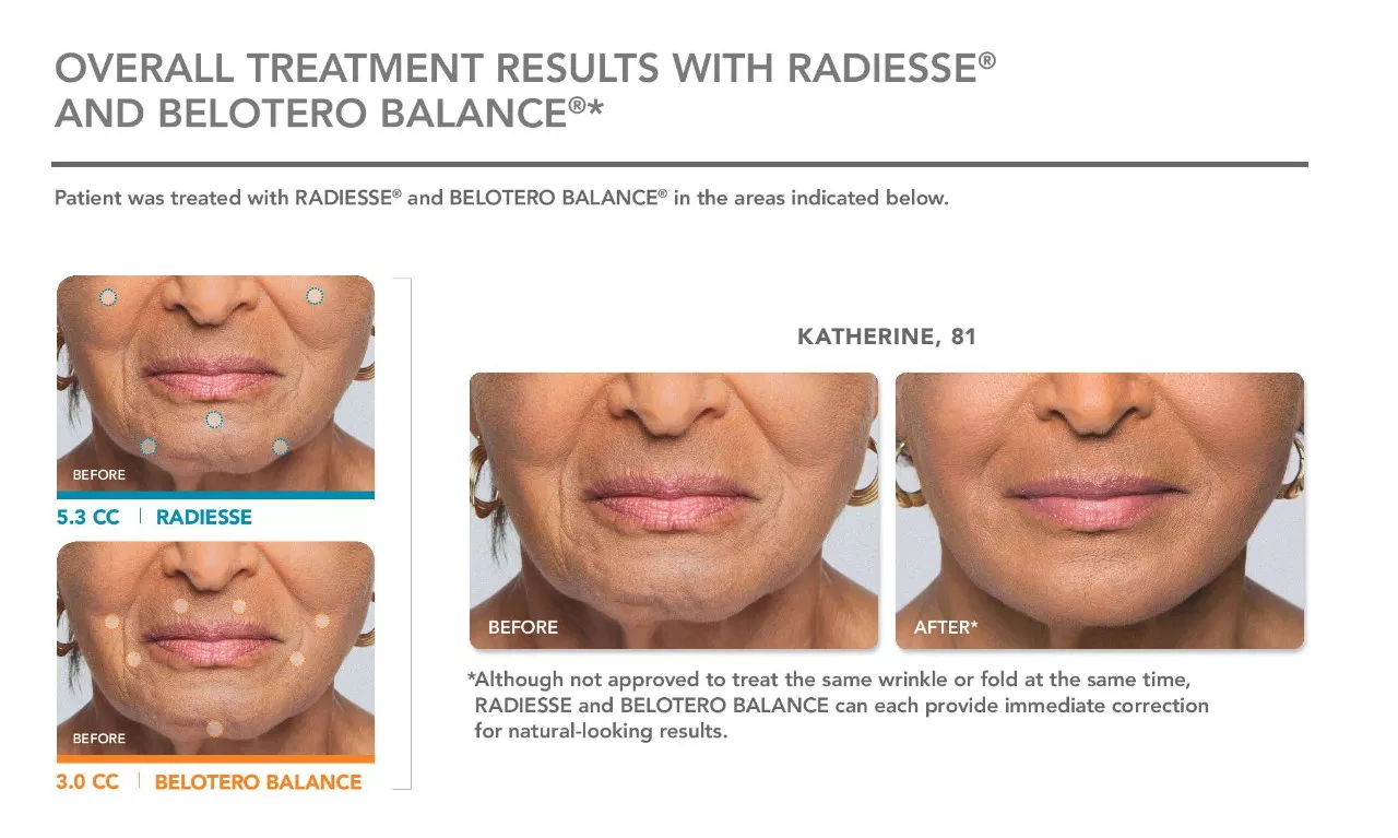 Belotero Balance Before and After