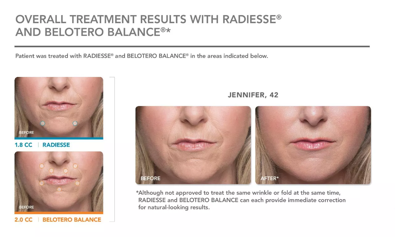 Belotero and Radiesse Before and after