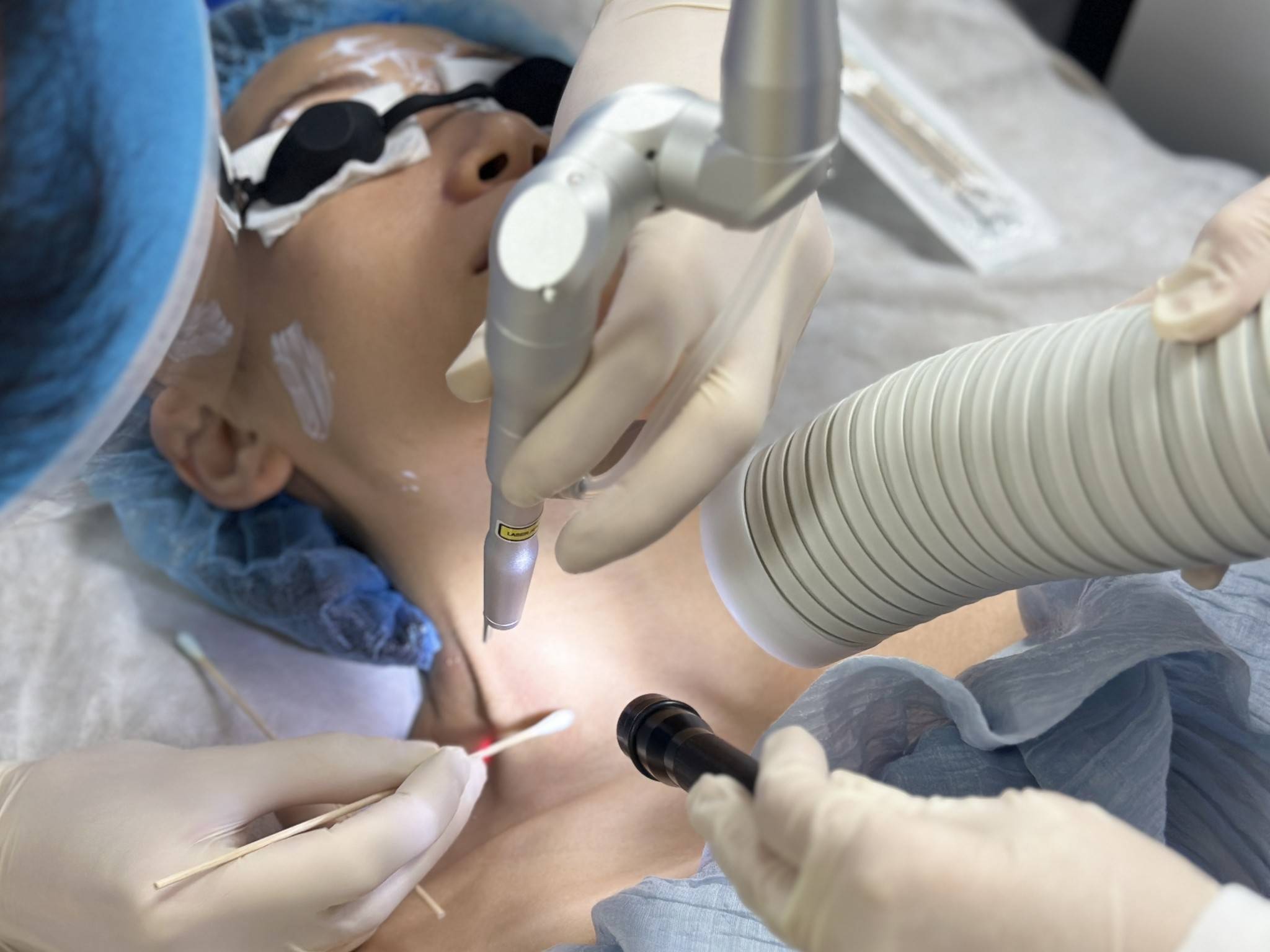 CO2 Laser Therapy - Lesion Removal - Our Services - Marina Medical