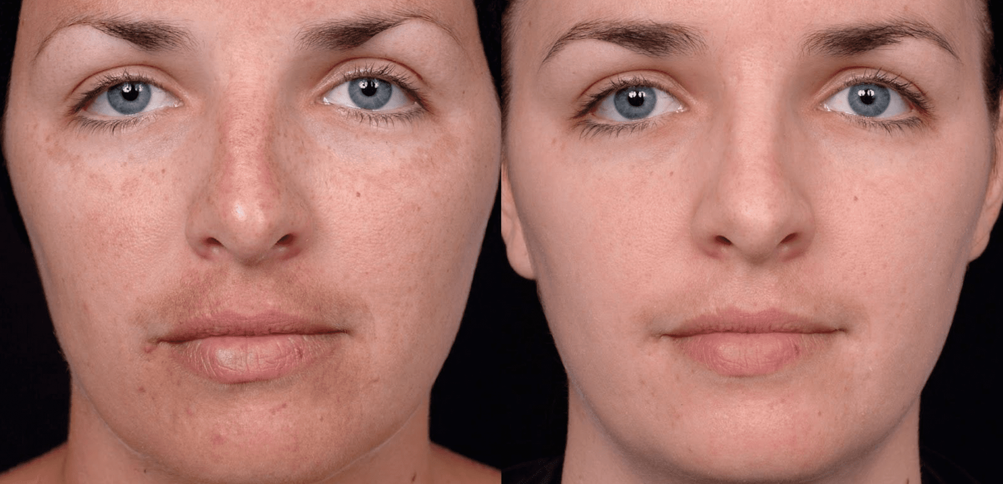 chemical peel before and after