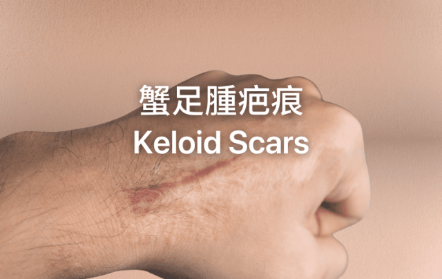 蟹足腫疤痕