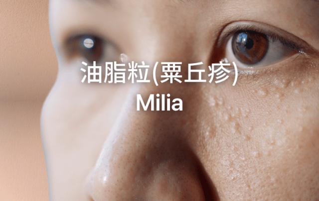 Mila-油脂粒（粟丘疹）